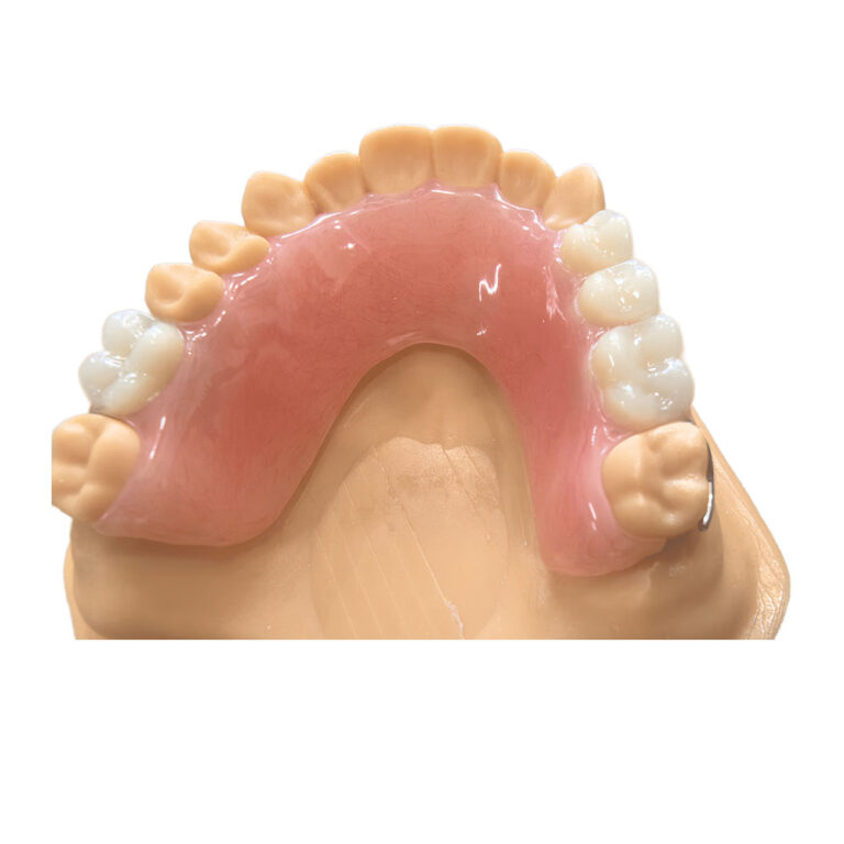 Unilateral Valplast Flexible Partial Denture