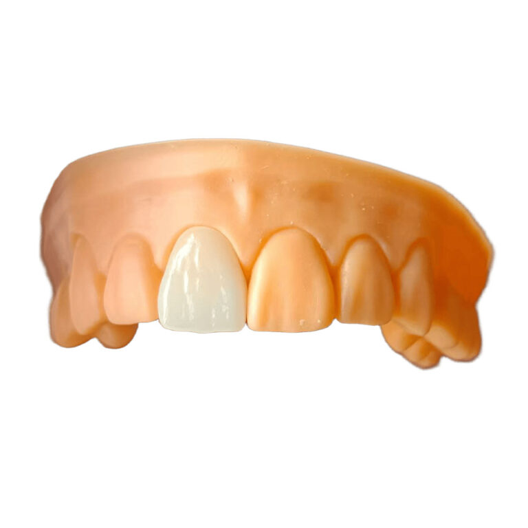 Upper Teeth Veneers