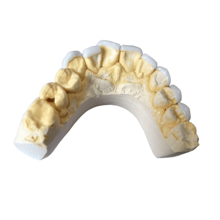 Upper And Lower Teeth Veneers