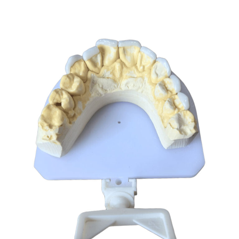 Upper And Lower Teeth Veneers