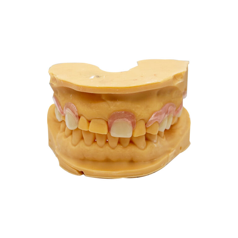 Upper Flexible Partial Dentures For Front and Back Teeth
