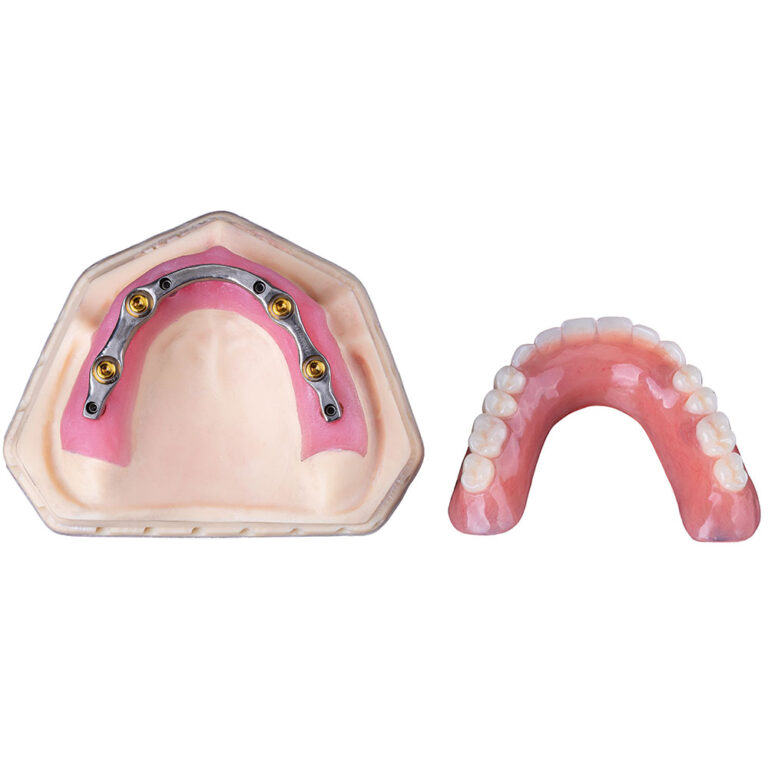 Upper Implant Denture