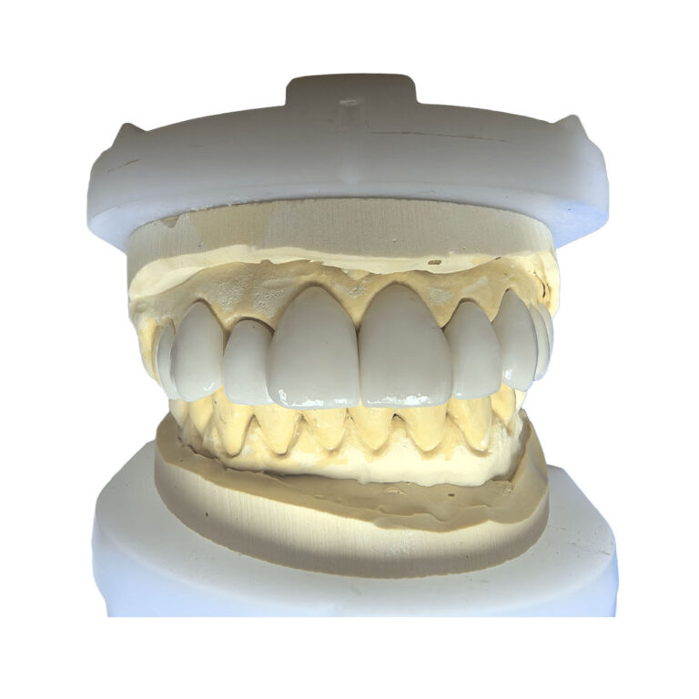 Upper Teeth Veneers