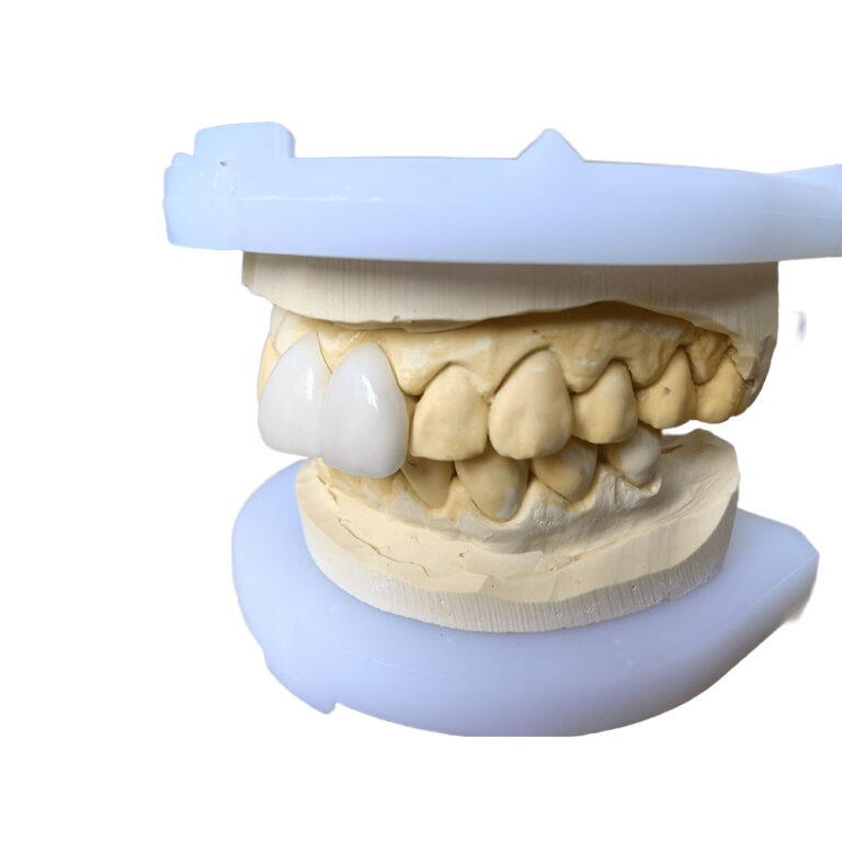 Veneers For Big teeth
