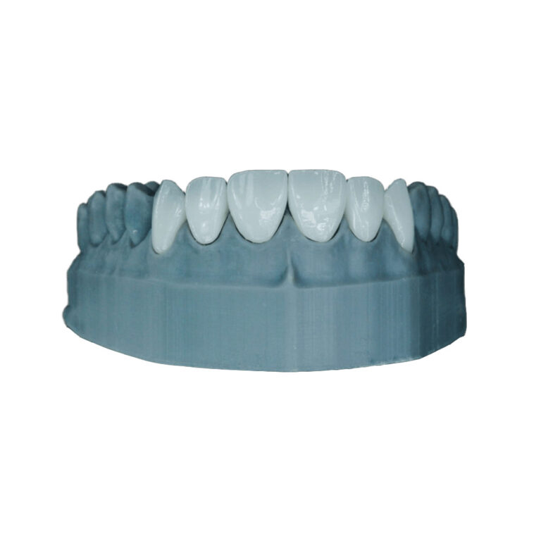 Zirconia Veneer