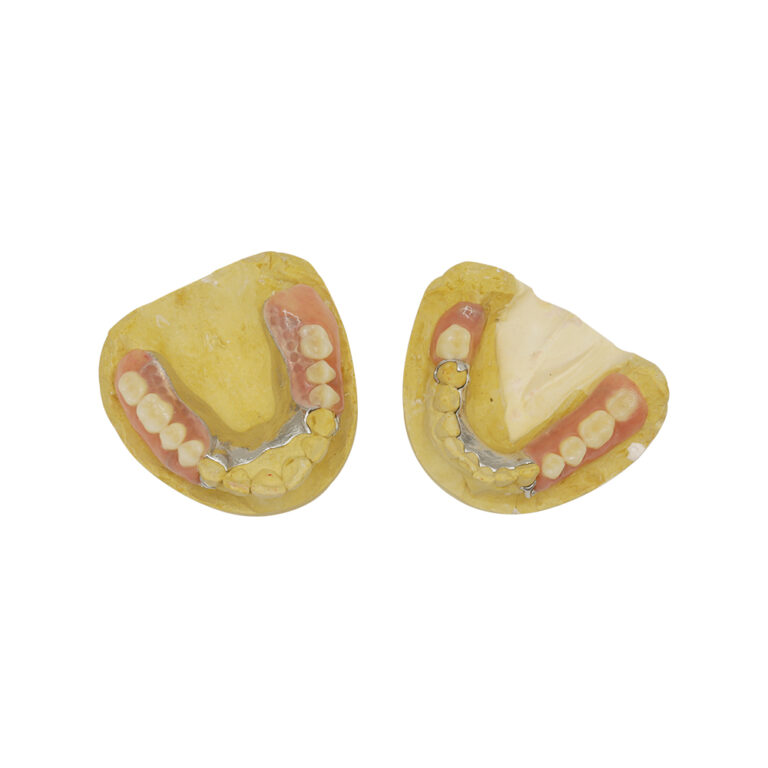 chromium cobalt denture