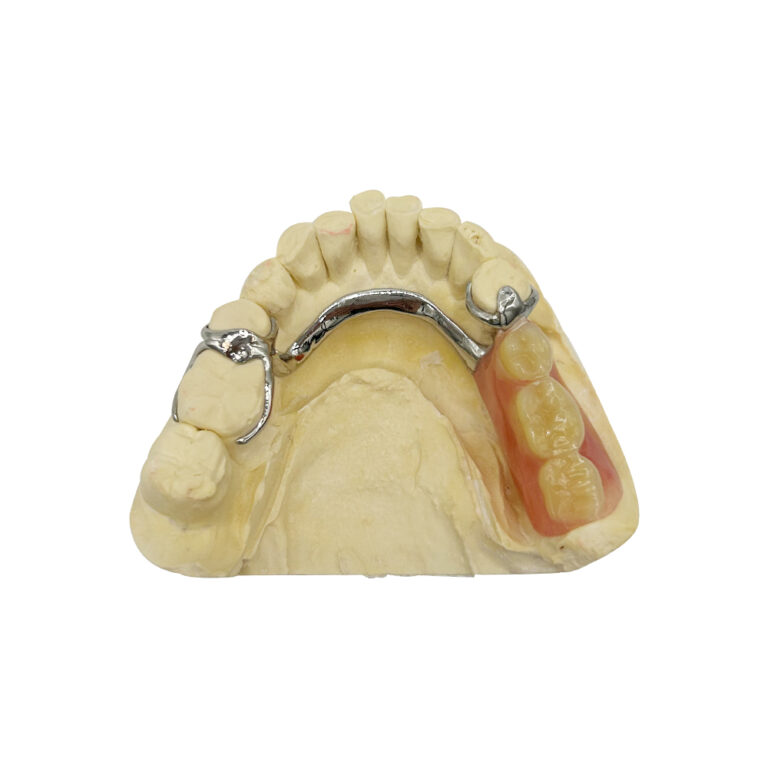 cobalt chrome denture