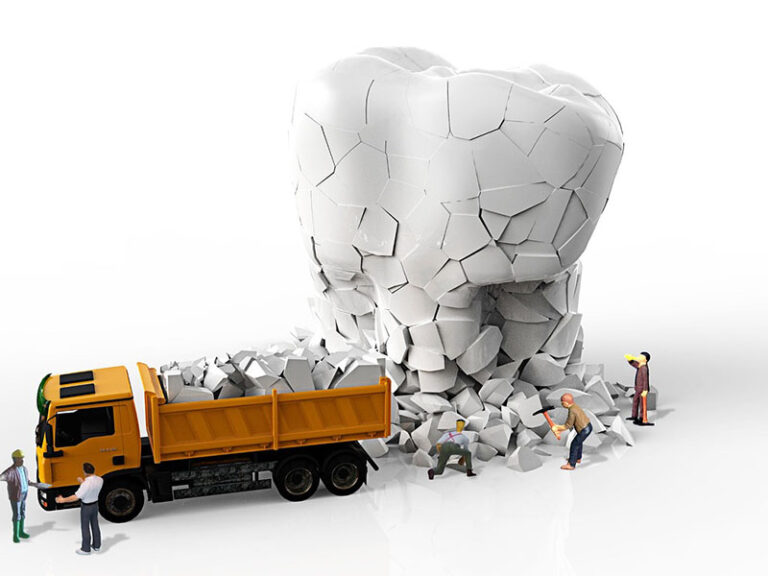 dental implants with bone loss