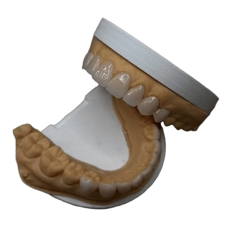 emax veneers (1)