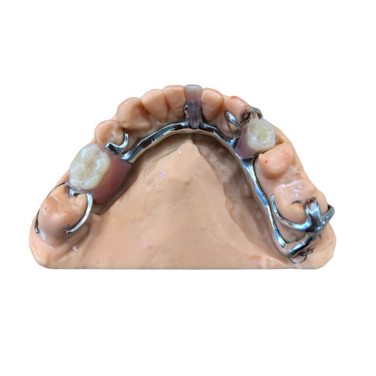 flexible denture with metal