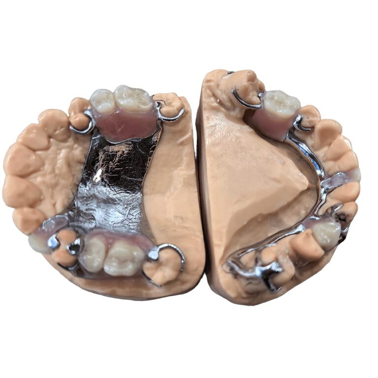 flexible denture with metal