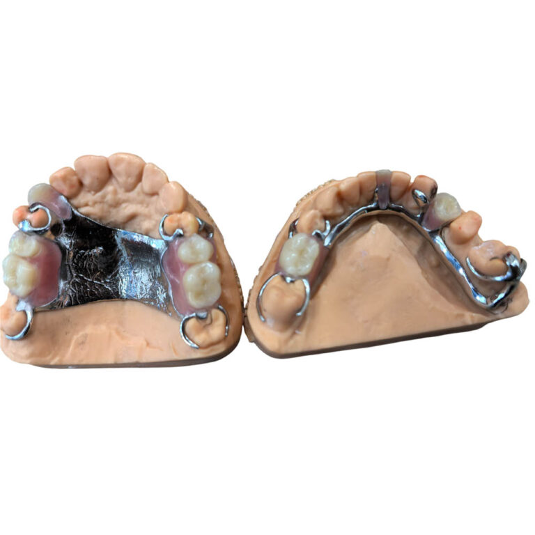 flexible denture with metal