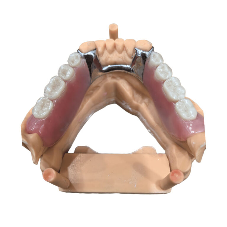 flexible denture with metal