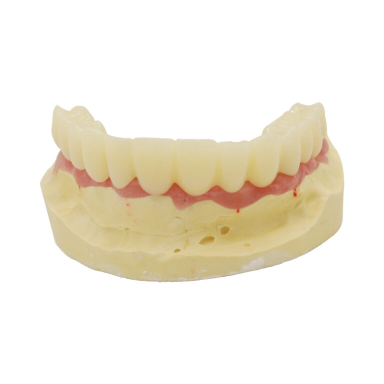 implant temporary bridge