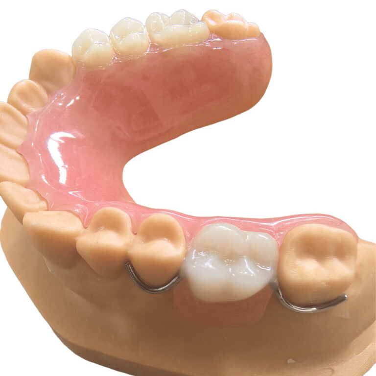 permanent partial dentures