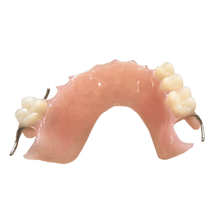 removable partial denture