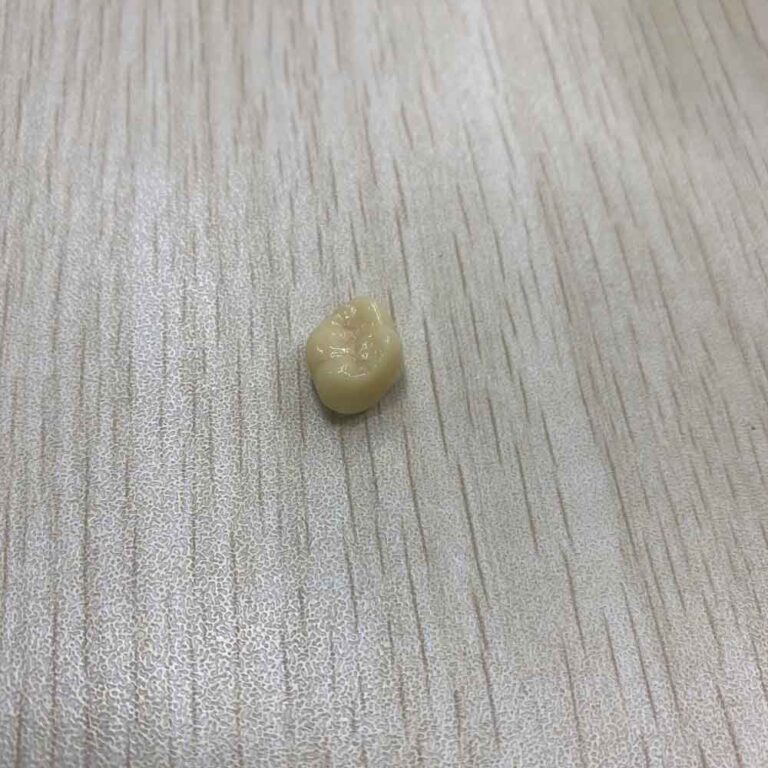 temporary crowns for molars