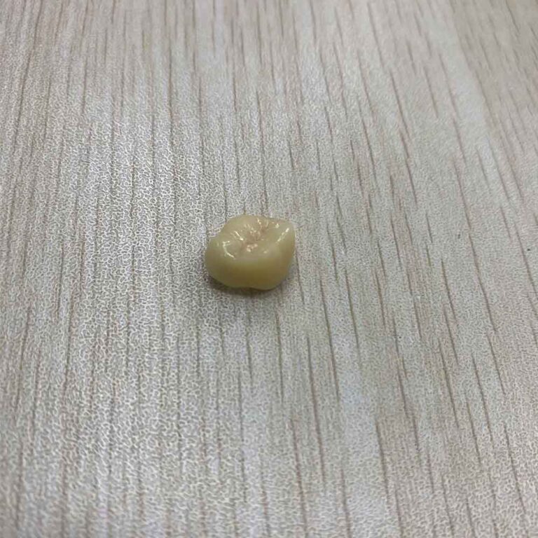 temporary crowns for molars