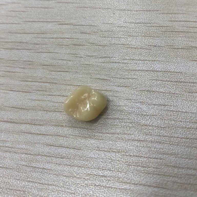 temporary lower teeth