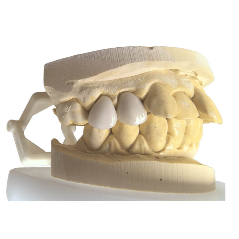 veneer molar teeth