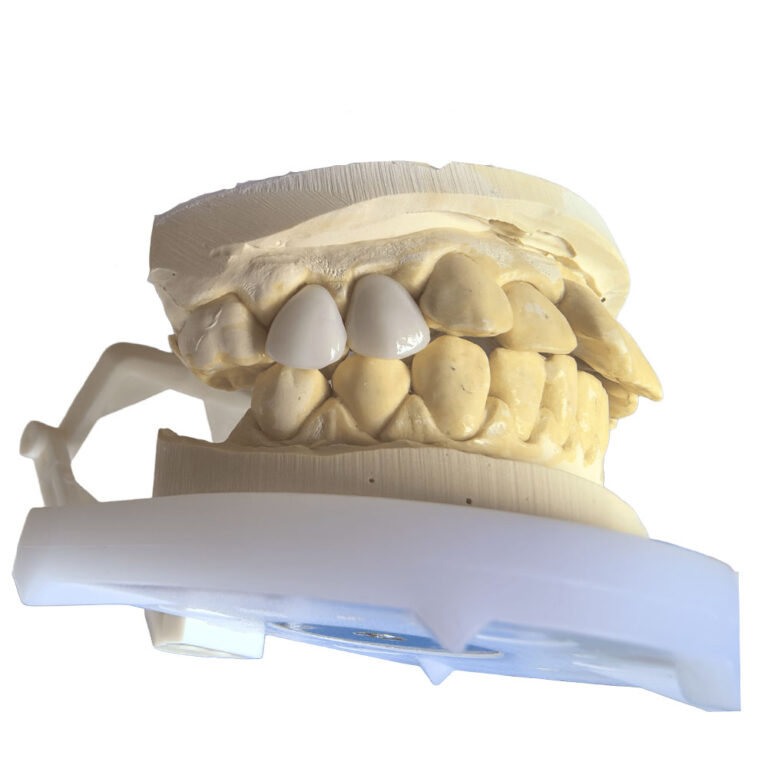 veneers for molar teeth