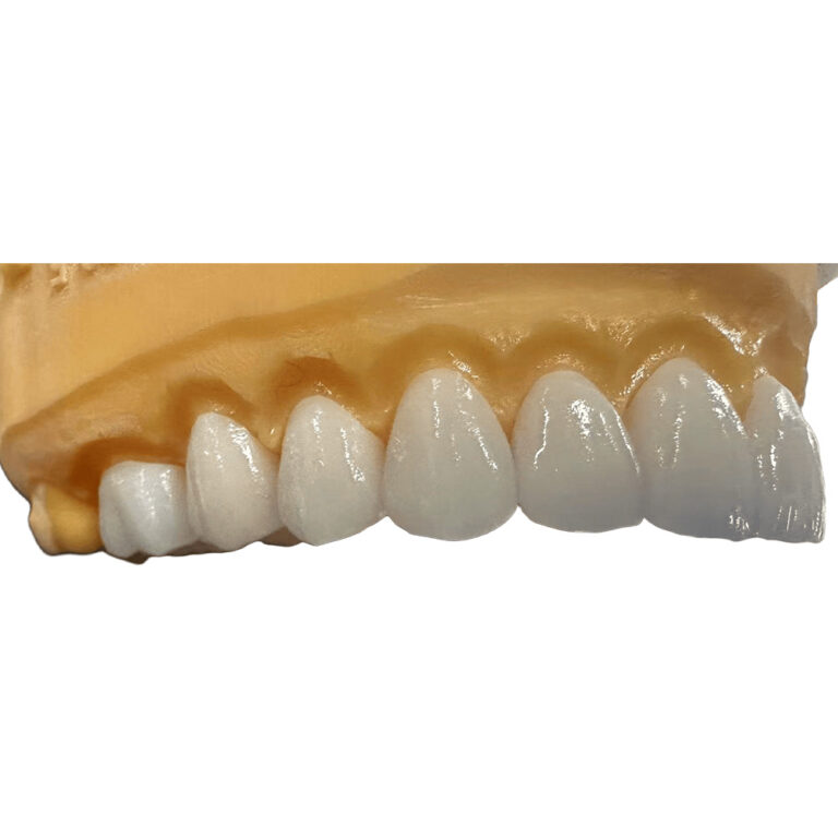 zirconia veneer 1
