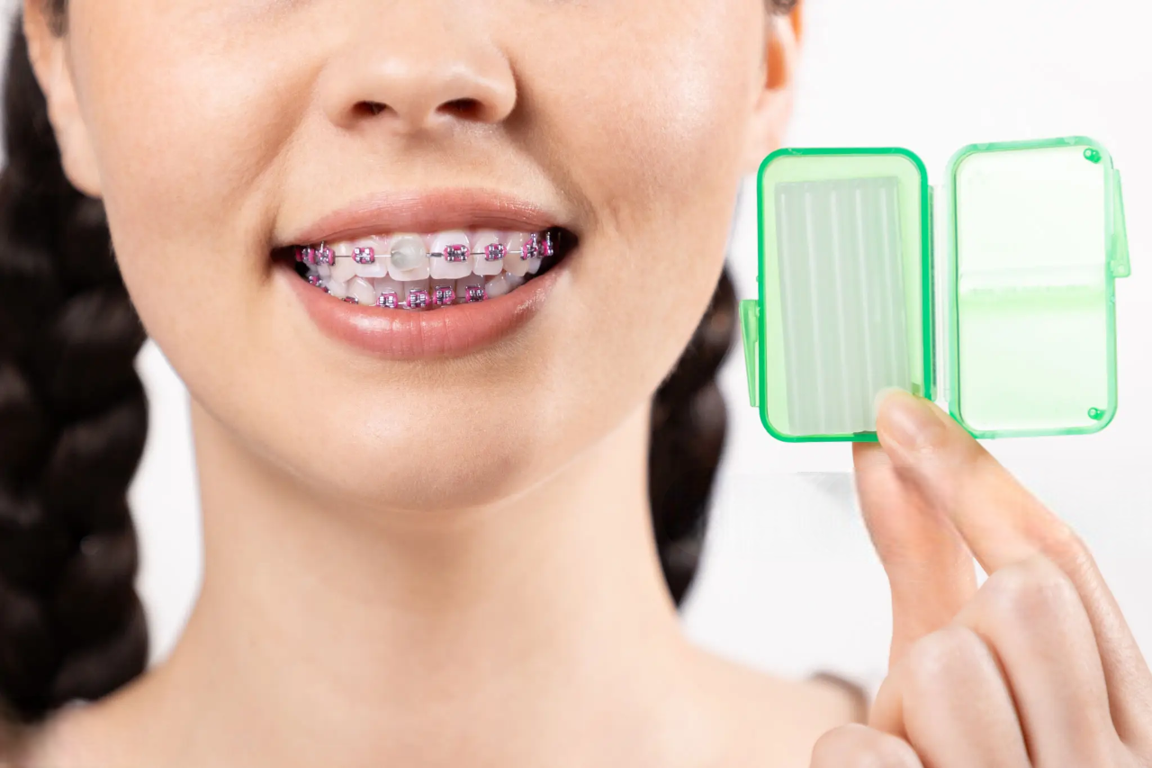 How to Apply Wax on Your Braces