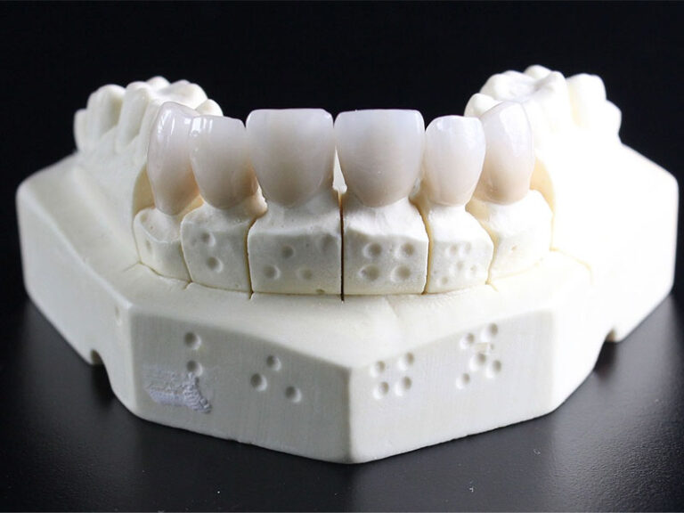 Acrylic vs Metal Partial Dentures