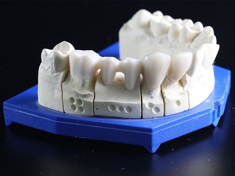 Acrylic vs Metal Partial Dentures1