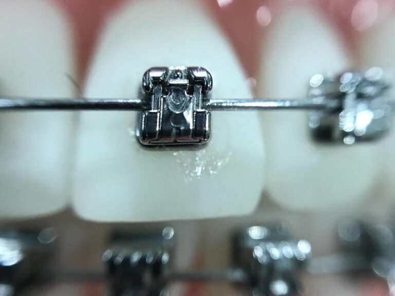 Arch Wires in Orthodontic Treatment