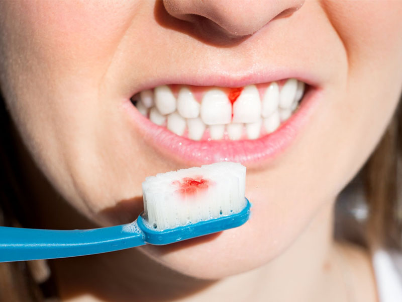 Bleeding Gums