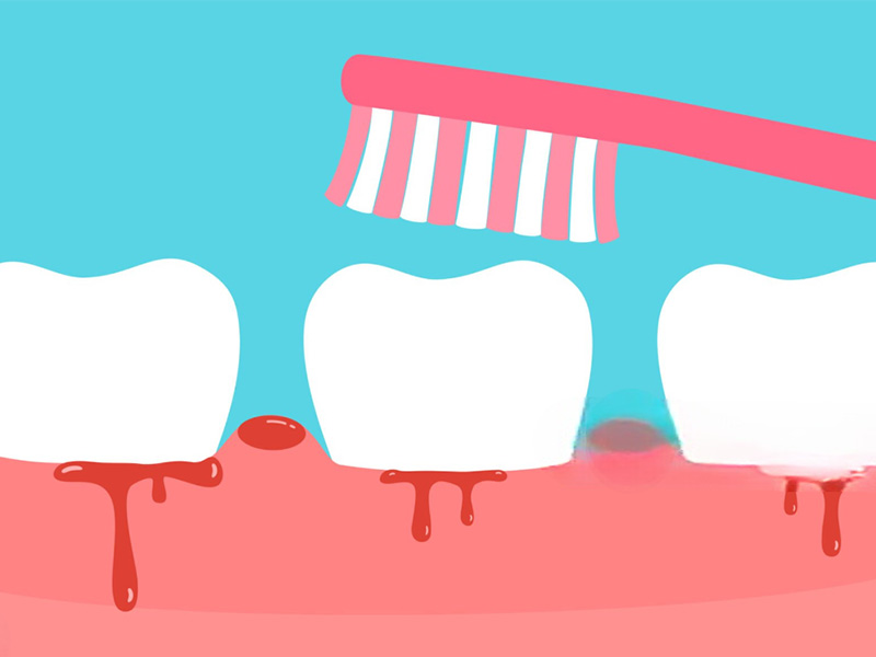 Bleeding Gums1