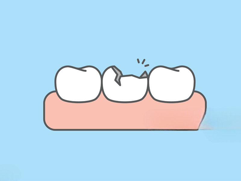 Broken Teeth