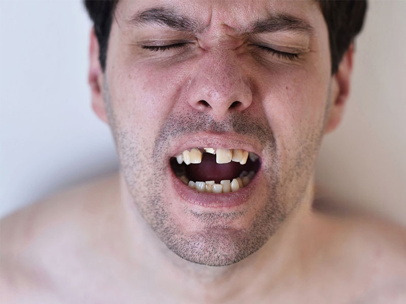 Broken Teeth: A Comprehensive Guide to Tooth Repair