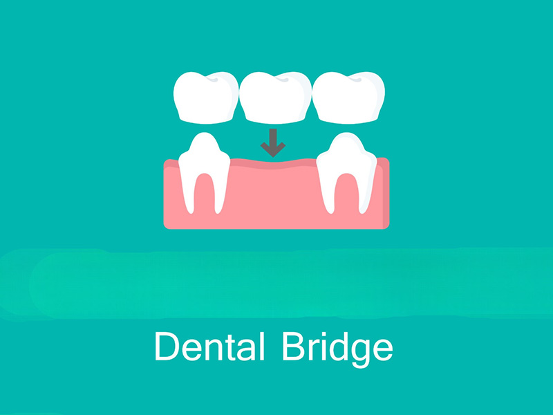 Dental Bridge1