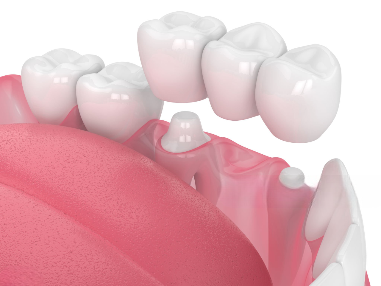 Dental Bridge1 1
