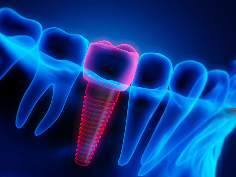 Dental Implant