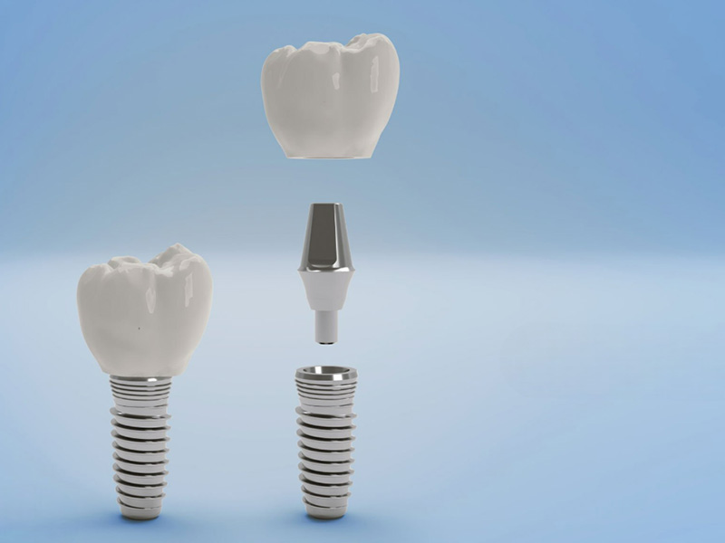 Dental Implant