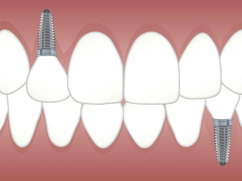 Dental Implant Abutments