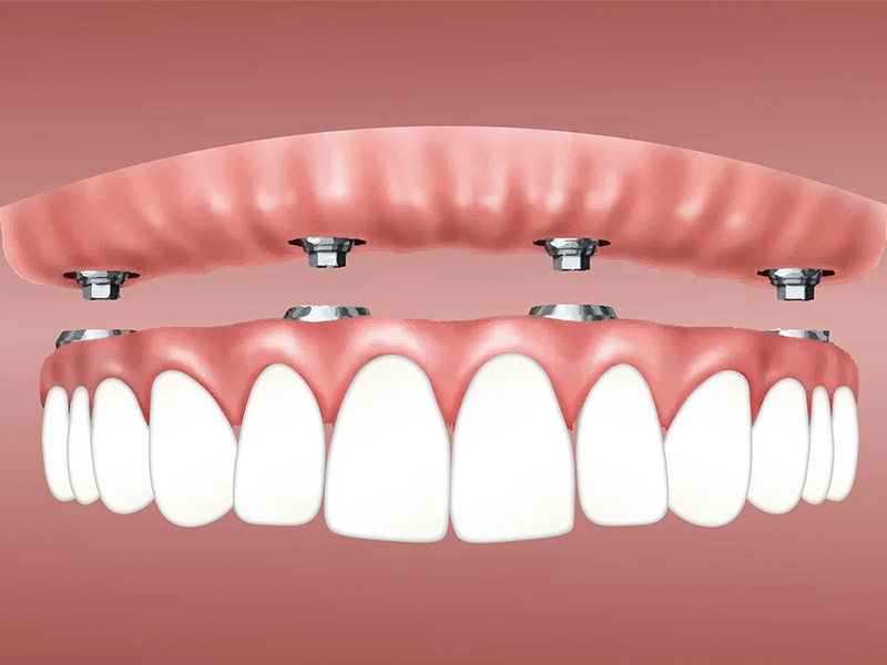 Dental Implant Abutments1