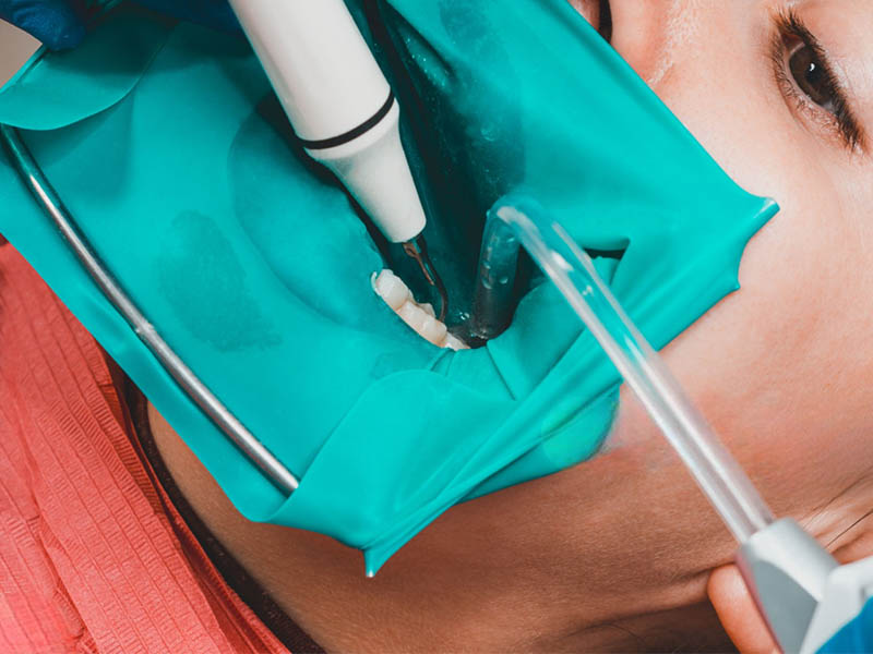 Dental Sealants1 1