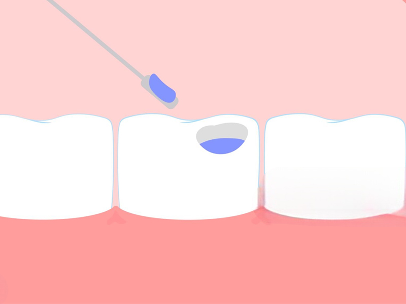 Dental Sealants