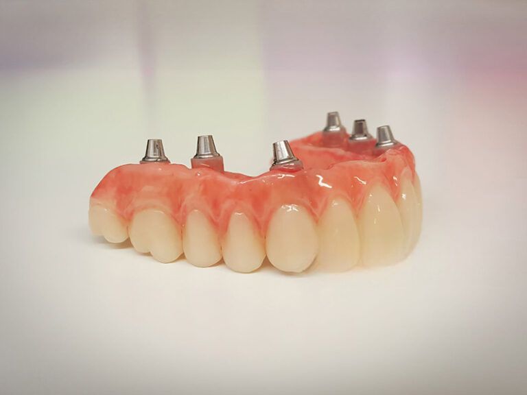 Denture Implant