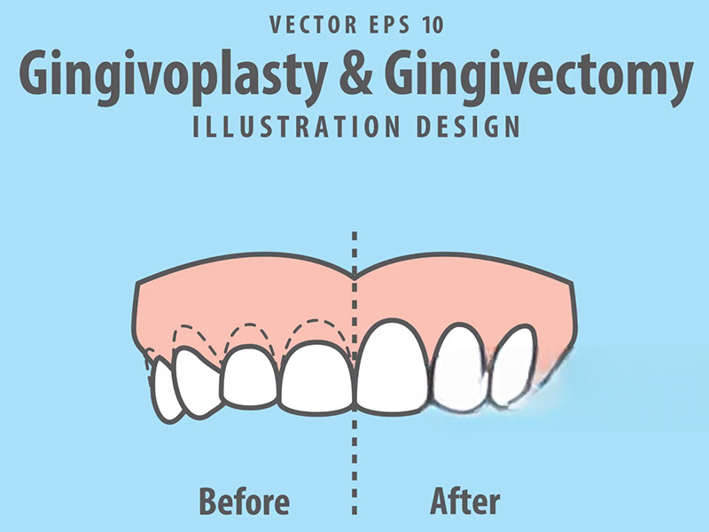Gingivectomy Guide1