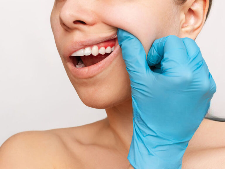 Gingivectomy Guide