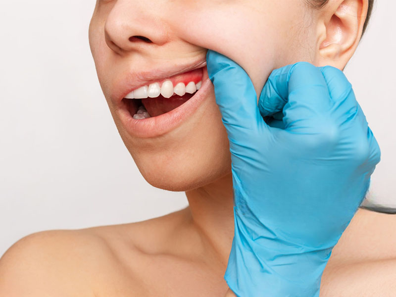 Gingivectomy Guide
