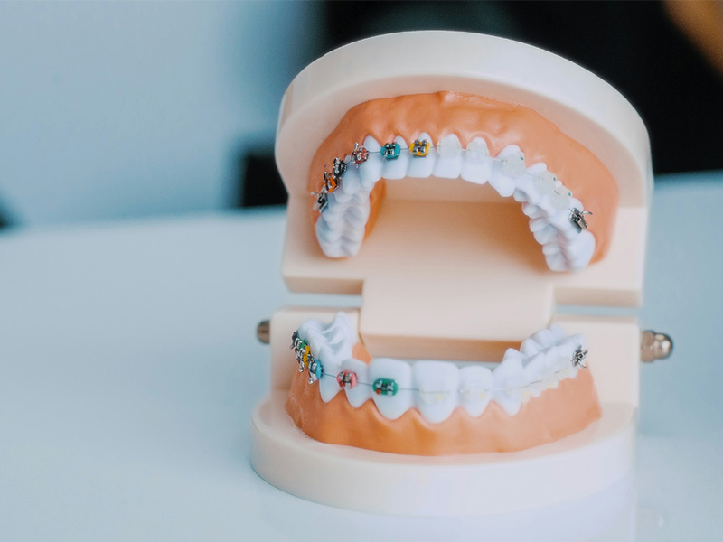 Orthodontics brace