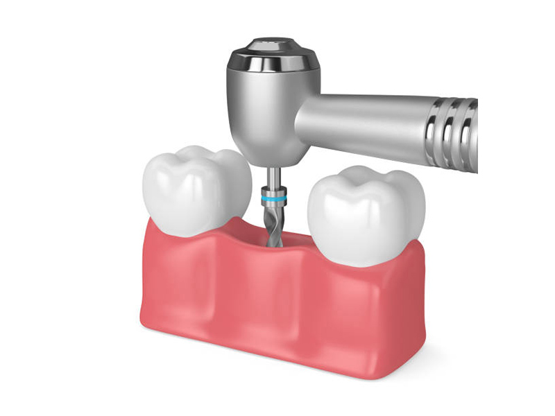 Revolutionizing Implant Dentistry1