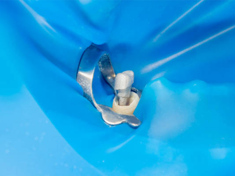 Rubber Dam Isolation 2