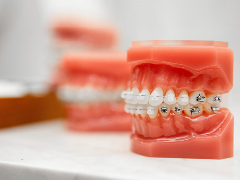 Self-Ligating Braces